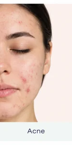 Acne Skincare Portrait Card