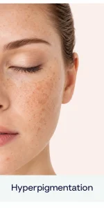 Hyperpigmentation Skincare Portrait